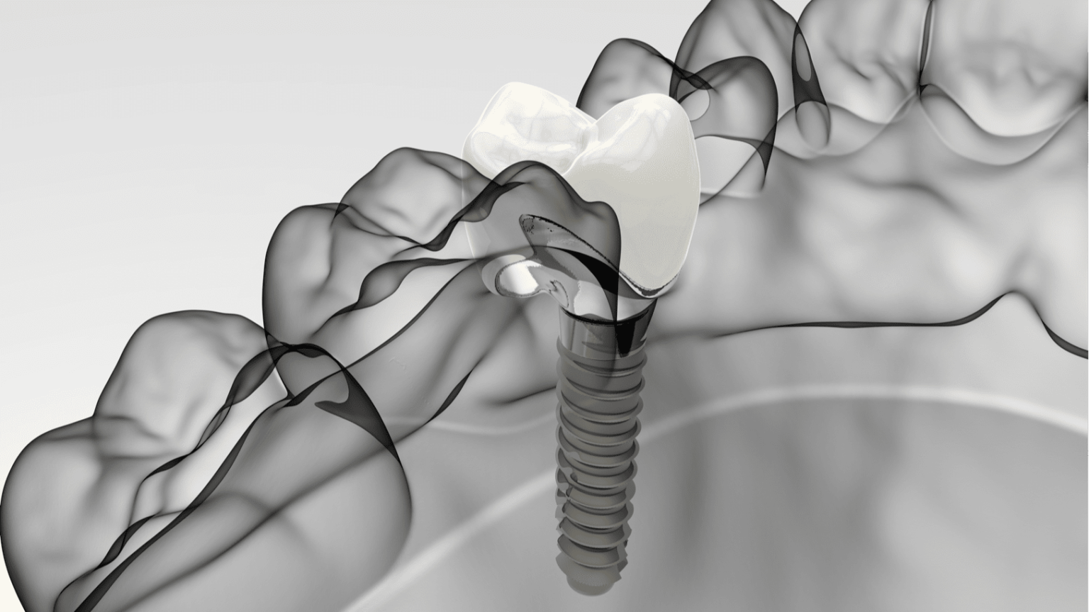 Dental Implants Congleton Cheshire Consultations Now Available for Private Patients at Crown Bank Dental